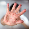 Mexico Measles Outbreak