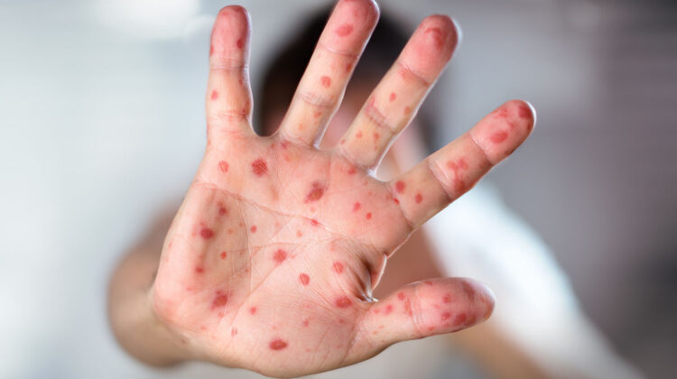 Mexico Measles Outbreak