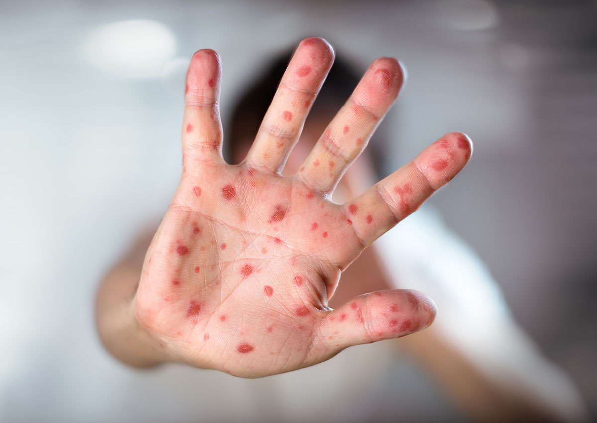Face Mask and Antiviral Sales Jump 17% as Mexico Measles Outbreak Spreads